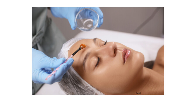 Chemical Peels